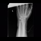 Calcification in TFCC, triangular fibrocartilage complex: X-ray - Plain radiograph